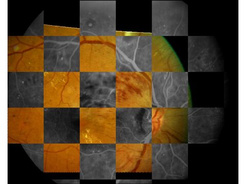 Figure from: Robust matching of multi-modal retinal images using radon transform based local descriptor